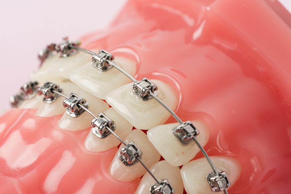 רשלנות רפואית ביישור שיניים